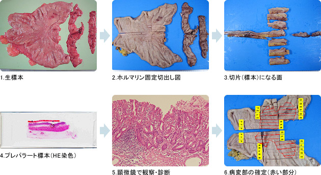 胃手術標本の病理組織検査