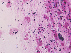 トレッドミル運動負荷検査