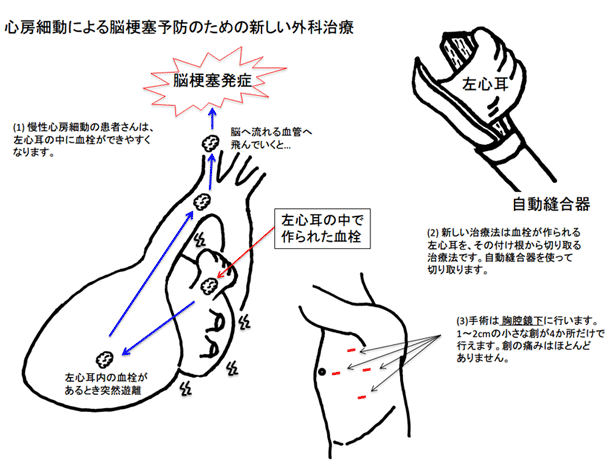 心房細動による脳梗塞予防のための新しい外科治療